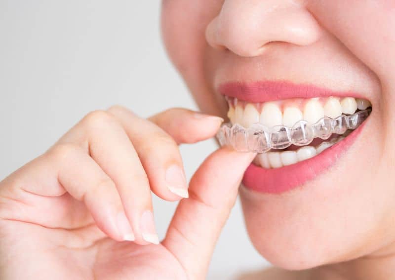 Invisalign