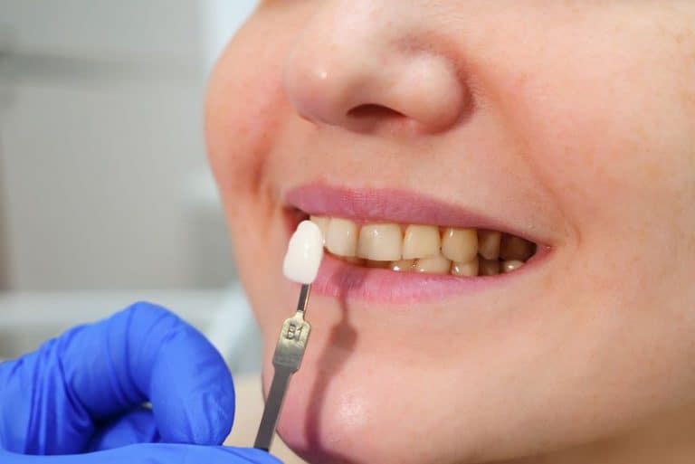 Carillas Dentales: Tratamientos Y Precios | Clinica B. Murri