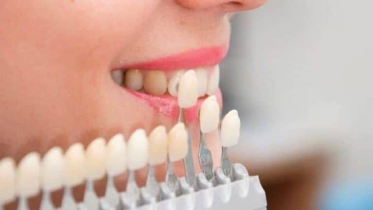 Carillas Dentales: Tratamientos Y Precios | Clinica B. Murri