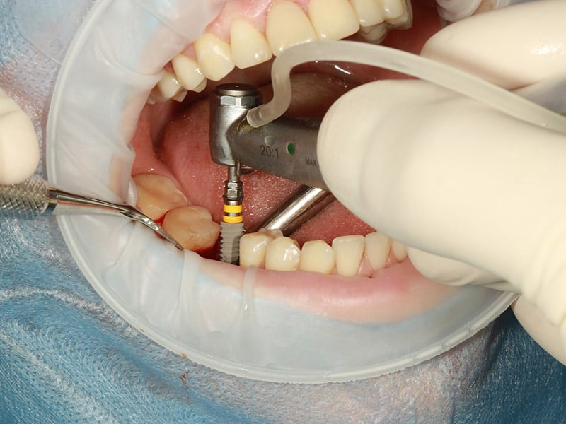 cuidado-implantes-dentales