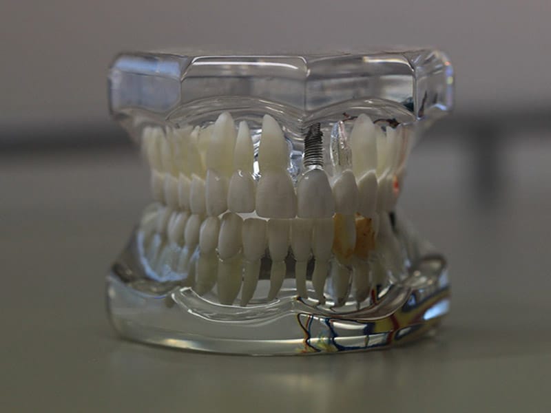 Prótesis Dentales Fijas | Qué Son, Tipos Y Sus Beneficios