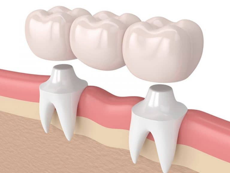 Prótesis Dentales Fijas | Qué Son, Tipos Y Sus Beneficios